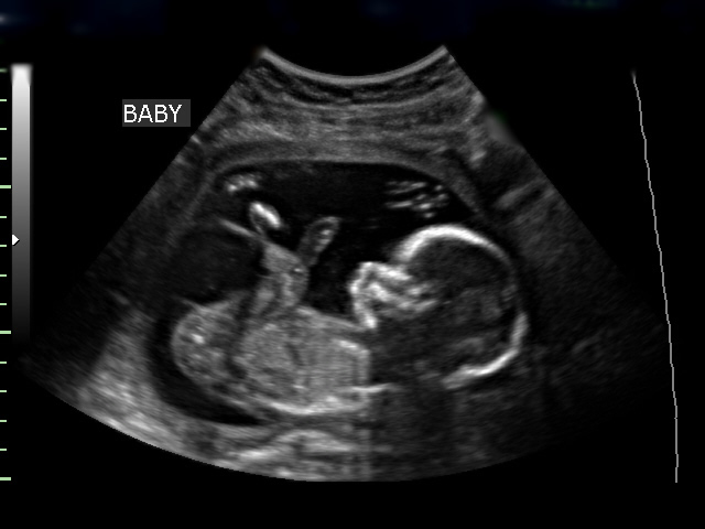 The Importance Of Having A Baby Ultrasound | D' Baby World